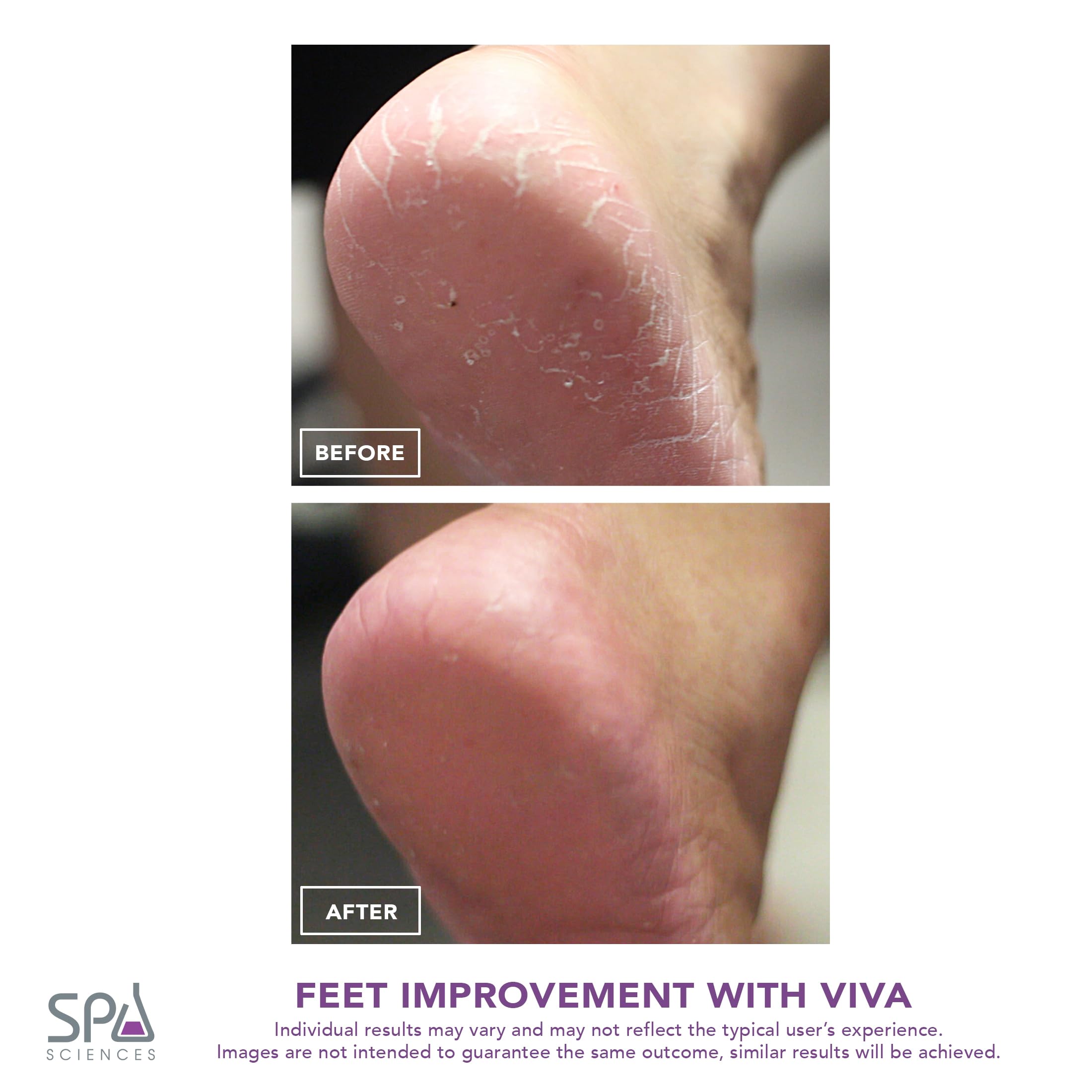 Spa Sciences VIVA Most Powerful Pedicure Tool Available-Professional Electronic Foot Smoothing Pedi Tool for Removing Hard, Dry, Cracked Skin/Calluses on Feet, Rechargeable-2 Treatment Heads Included